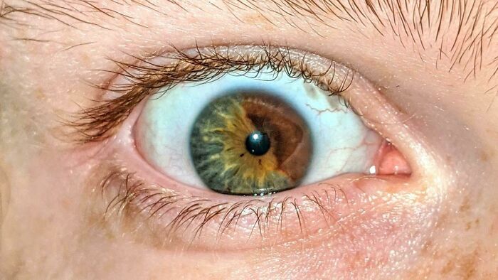 Mildly Interesting Photo Of My Eye That I Managed To Get In Focus, I Have Sectoral Heterochromia