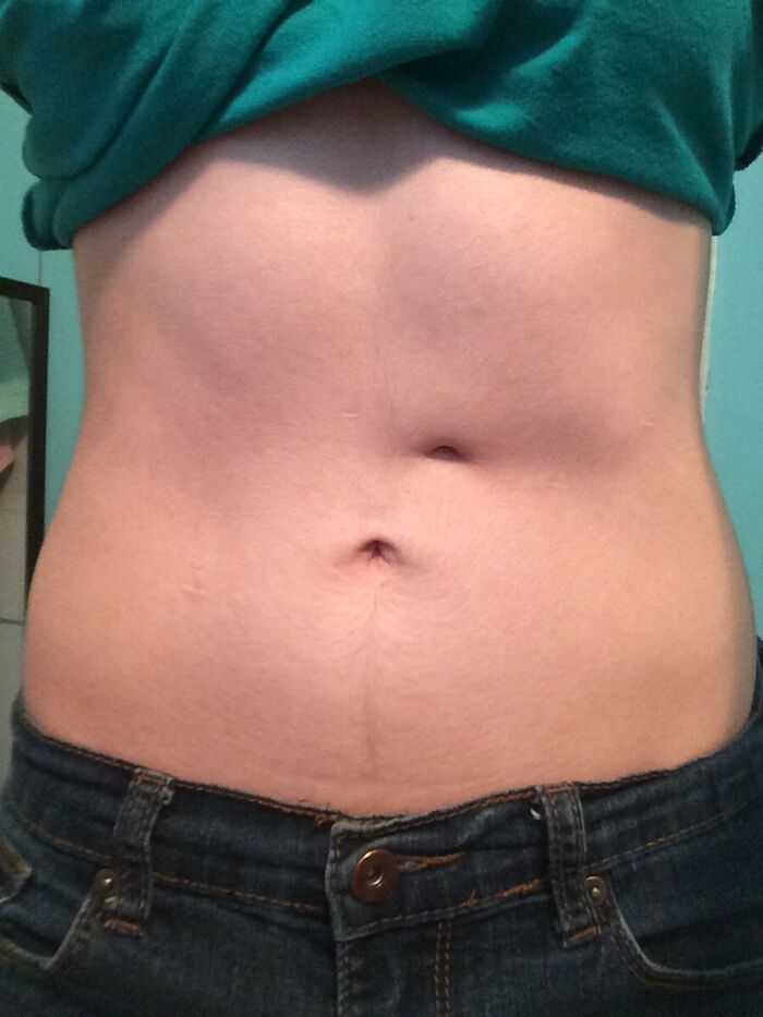 I Have Cystic Fibrosis. One Of My Scars Looks Like A Second Bellybutton