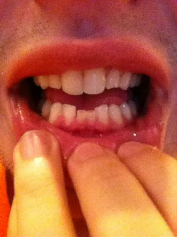 I'm 21 And Still Have 2 Baby Teeth