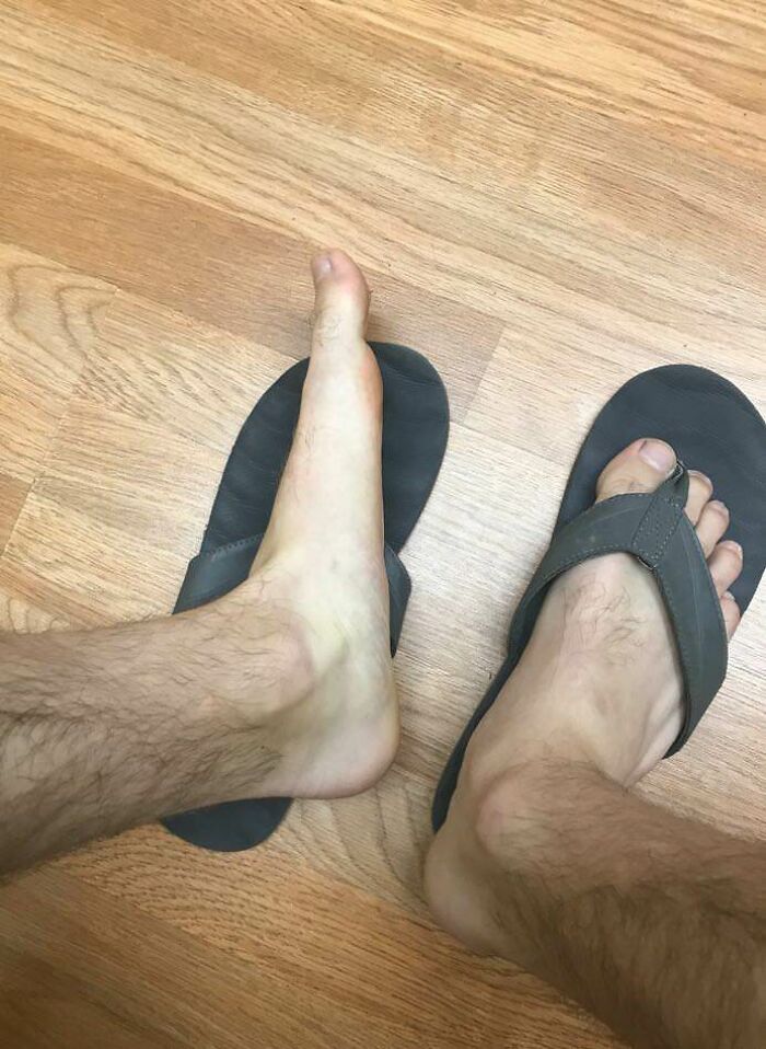 My Feet Are Totally Flat