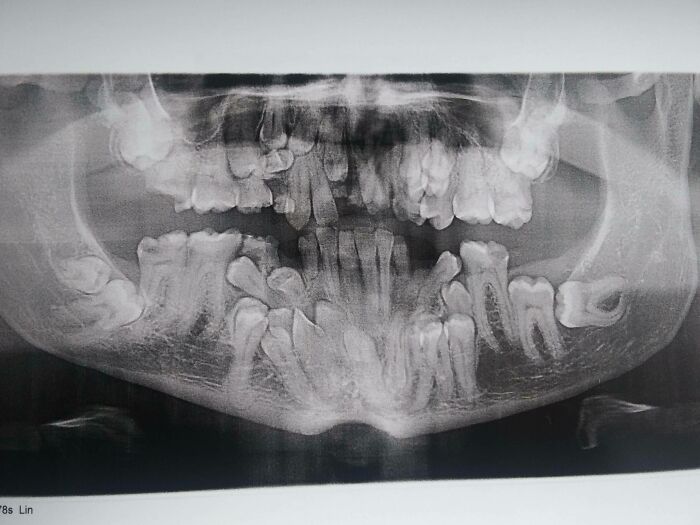 I Have A Rare Disorder Called Cleidocranial Dysotosis. Got My First Dental X-Ray Today And I Have A Lot Of Extra Teeth