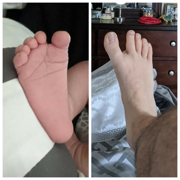 My Wife Just Gave Birth To Our Firstborn, And Me And My Son Both Have The Same Weird Genetic Abnormality Where We Have An Extra Large Space Between Our First And Second Toes