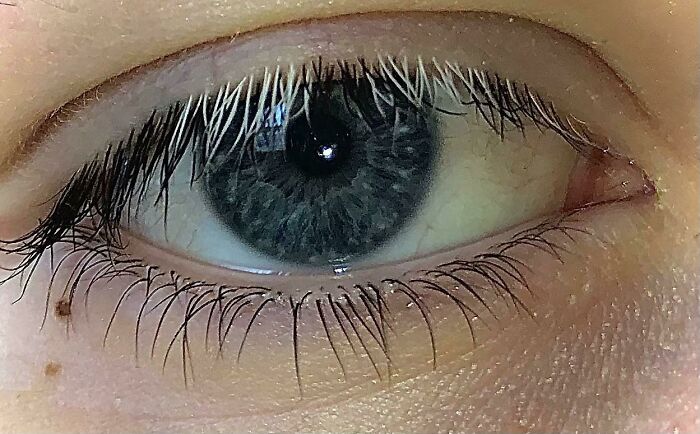 My Eyelashes On My Right Eye Started Growing White A Few Months Ago