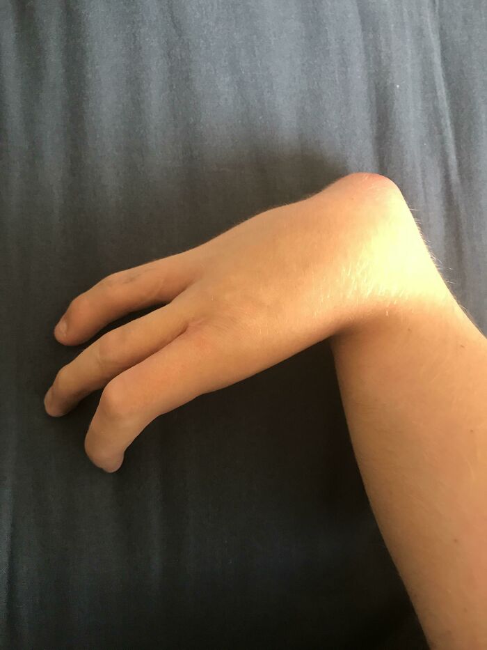 Been Seeing A Lot Of 4 Finger Havers, Here's Me! I Was Born With 3 Of Them