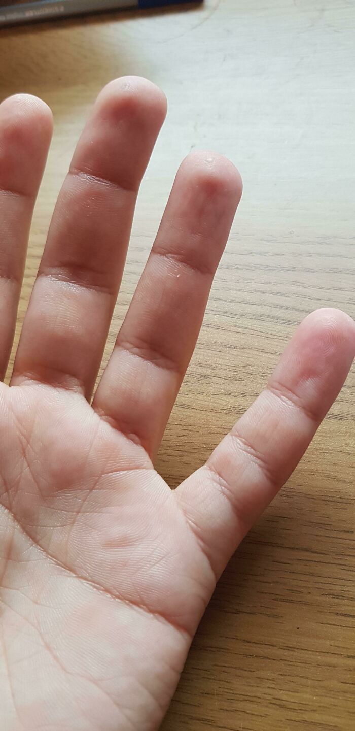 My Left Hand Pinky Finger Has An Extra Joint Crease But No Extra Joint