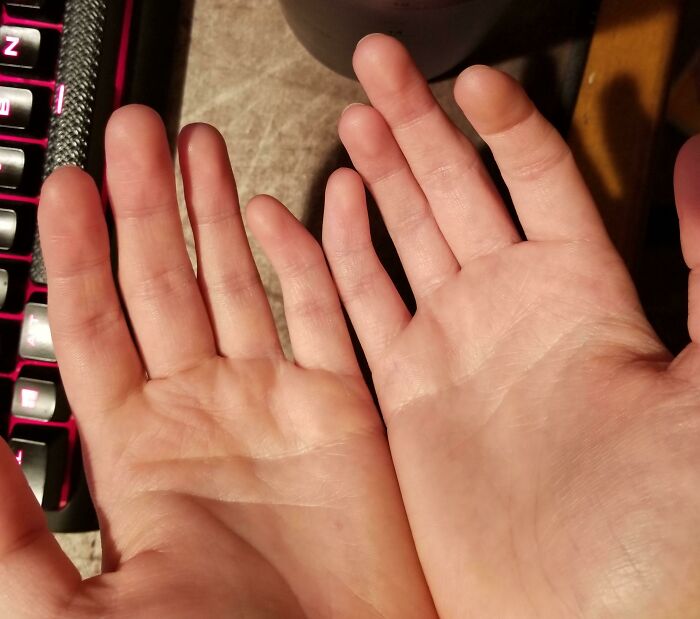 I Was Born With Crooked Pinkies, Which Is Also Called Clinodactyly