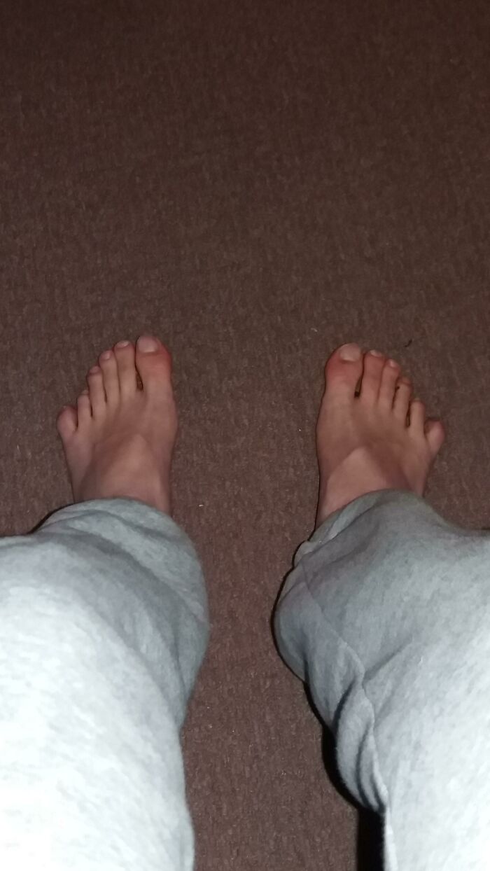 I Have Six Toes On Both Of My Feets