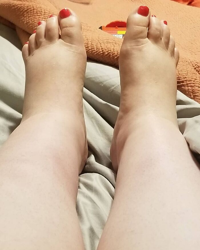 Pregnancy Cankles. Frantically Drinking Water, But They're Still Swollen. In The Bed To Let Them Chill While Patrick Gets Honey-Do Requests To Finally Start Hanging Photos In The Bedroom