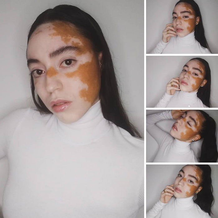 Woman With Vitiligo Overcomes Her Self-Confidence Issues After A Photoshoot With Famous Makeup Artist