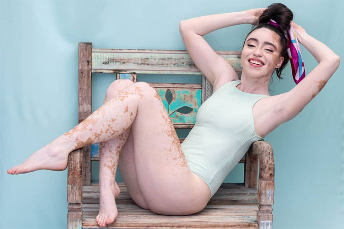 Woman With Vitiligo Overcomes Her Self-Confidence Issues After A Photoshoot With Famous Makeup Artist