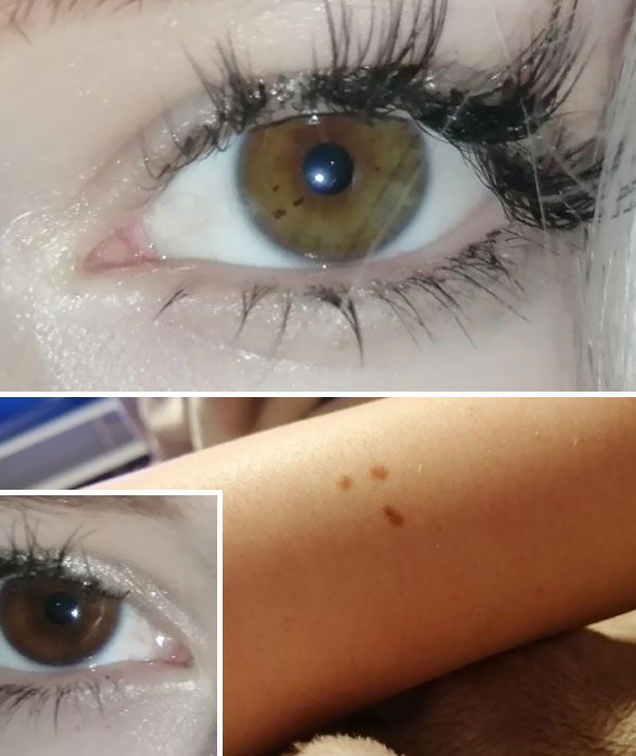 I Have Matching Triangle Freckles On My Arm And My Left Eye