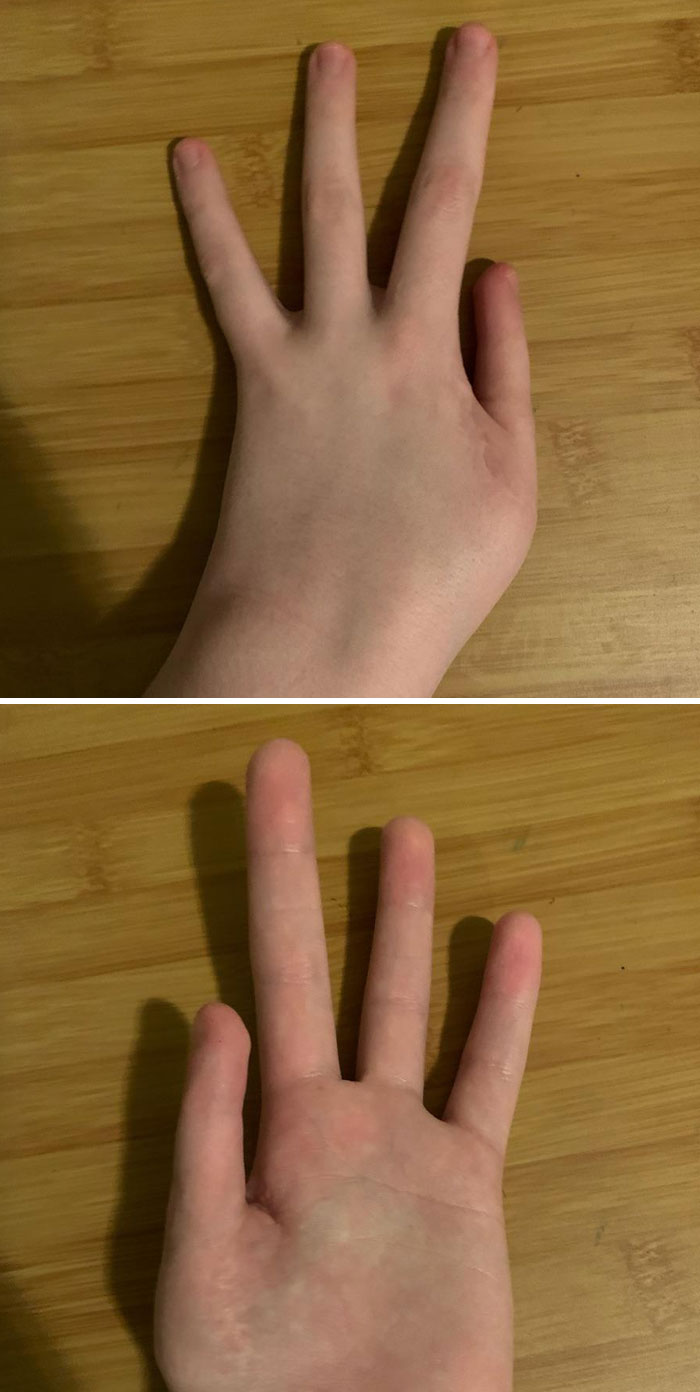 My Left Hand Is Missing A Finger As It Was What Formed My Thumb
