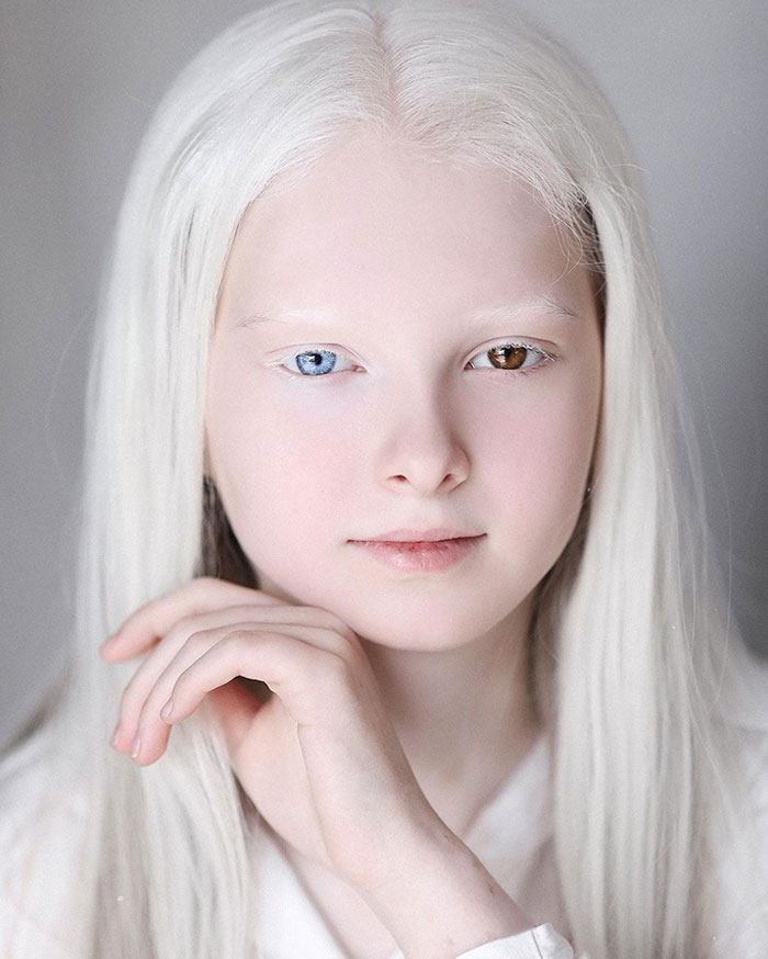 Amina Ependieva Has Two Rare Genetic Conditions: Albinism And Heterochromia