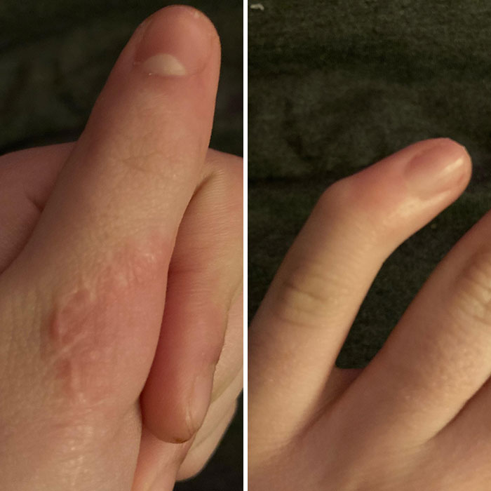 I Was Born With Something Called The Sonic Hedgehog Gene Where I Had Three Thumbs Also My Pinkies Are Extremely Crooked