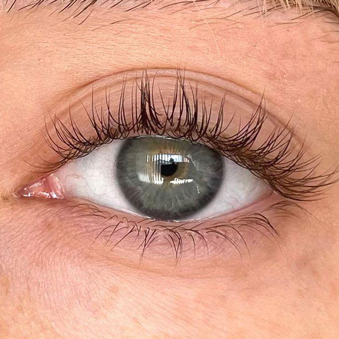 I Have A Rare Genetic Condition Called Distichiasis (A Double Row Of Eyelashes). Sometimes They Grow Into My Eyeball