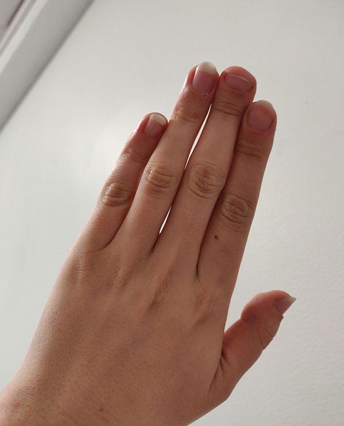 I Have Absolutely Ridiculously Flat, Wide And Ugly Middle Fingers And Thumbs Caused By Genetic Disorder Called Brachydactyly