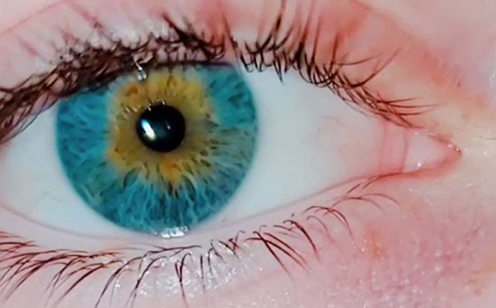 I Saw Some Say That They Have Sectoral Heterochromia, And I Raise You To Central Heterochromia