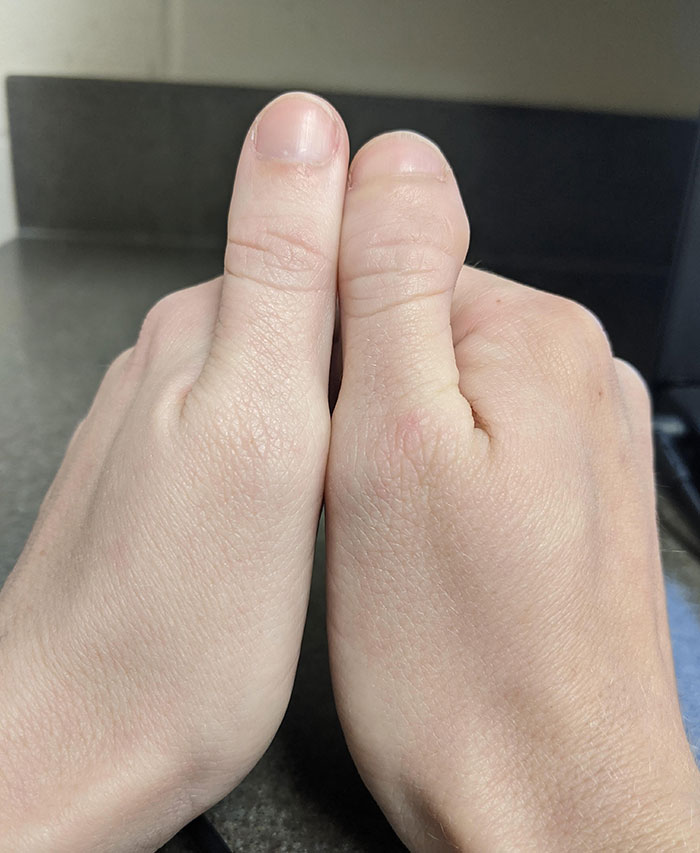 I Was Born With One Normal Thumb And One Toe Thumb