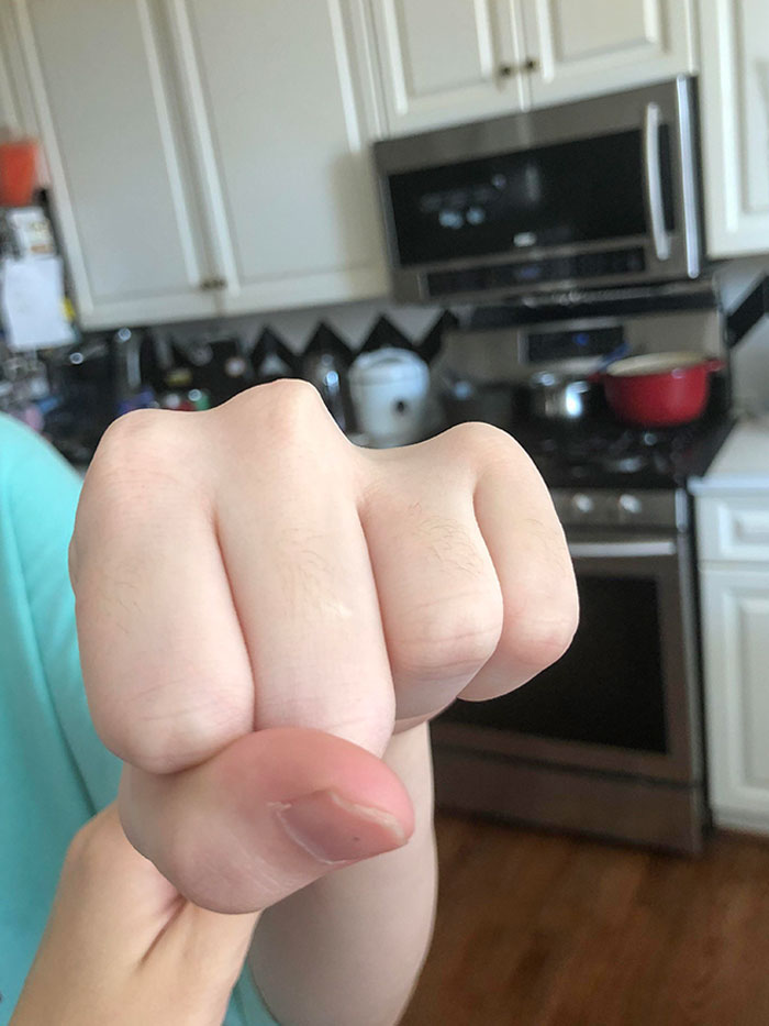 My Sister Has A Missing Knuckle. Her Finger Still Works But It’s Just Short