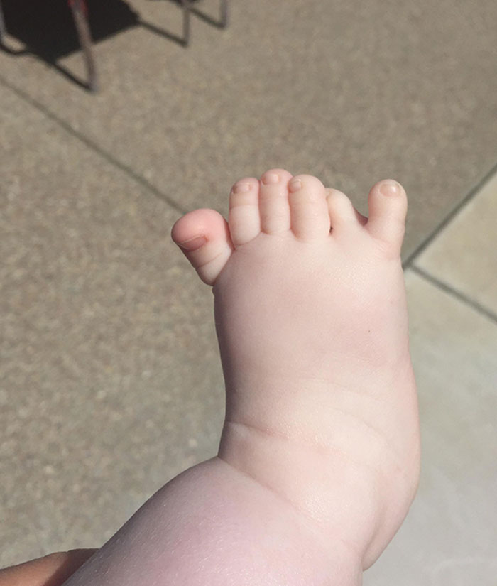 Met A New Cousin Yesterday With 6 Toes