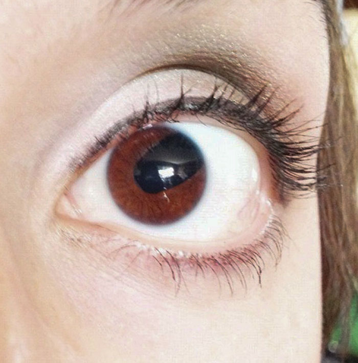 This Is My Sister's Eye. She Has A Condition Called "Coloboma"