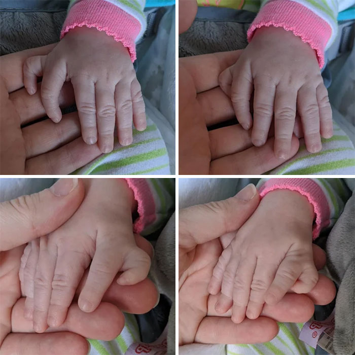 My Youngest Daughter Was Born This February With An Extra Finger On Each Hand