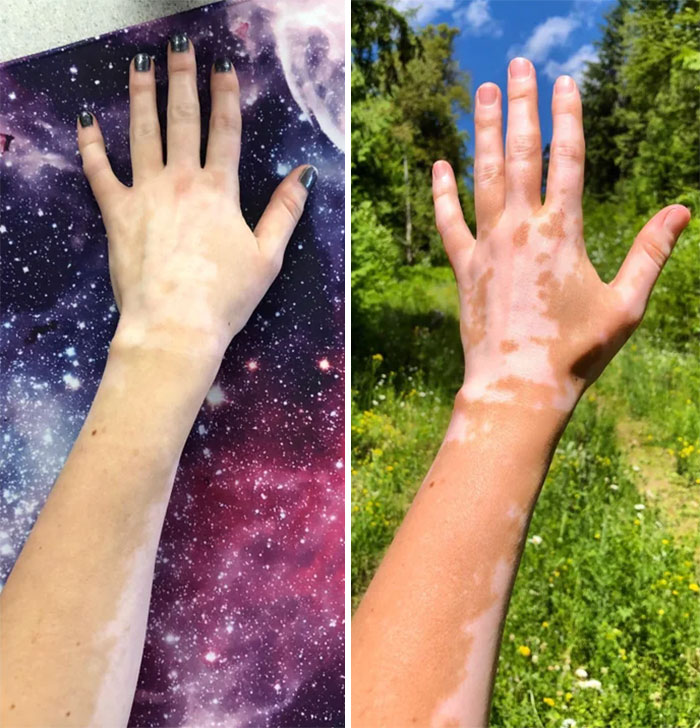 How My Vitiligo Changes From The Winter To The Summer