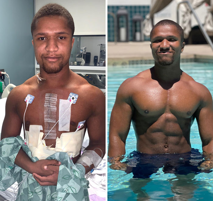 Saw The Left Picture On My Google Photos And Was Feeling Proud Of Myself. 1.5 Years Post Open-Heart Surgery
