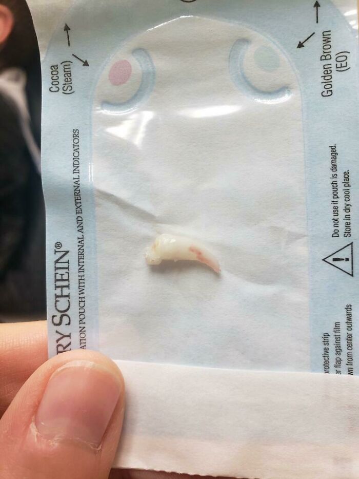 My 8yo Had This Freak Tooth Removed That Was Growing Out Of The Roof Of His Mouth Right Behind His Front Teeth