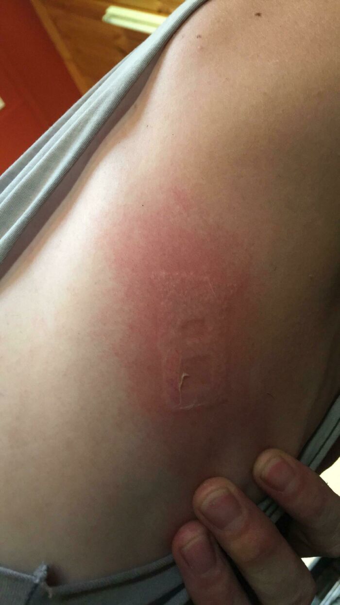 It Hit 45 Degrees Celsius In Our Area Today And My Boyfriend Got Instantly Branded By His Seat Belt Buckle Getting Into His Car. It’s Already Peeling