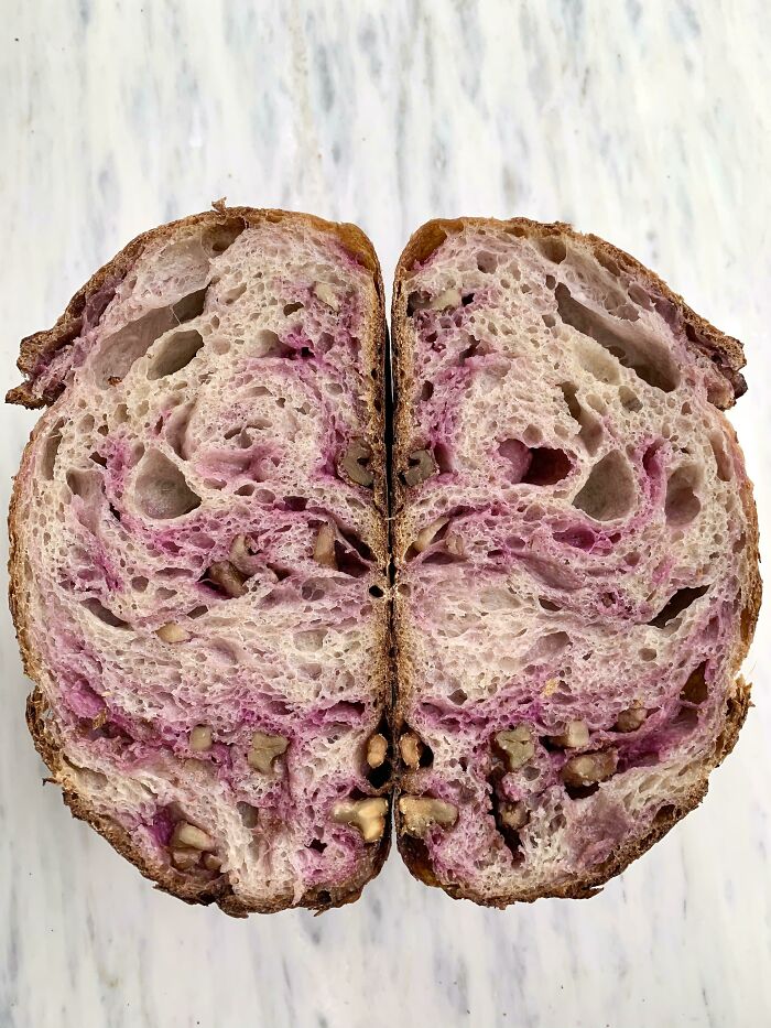 Brain Scan Of A 82-Year-Old Man With Alzheimer's