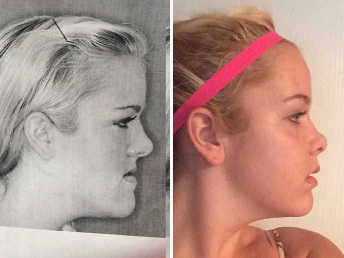 The Before And After Of My Jaw Surgery
