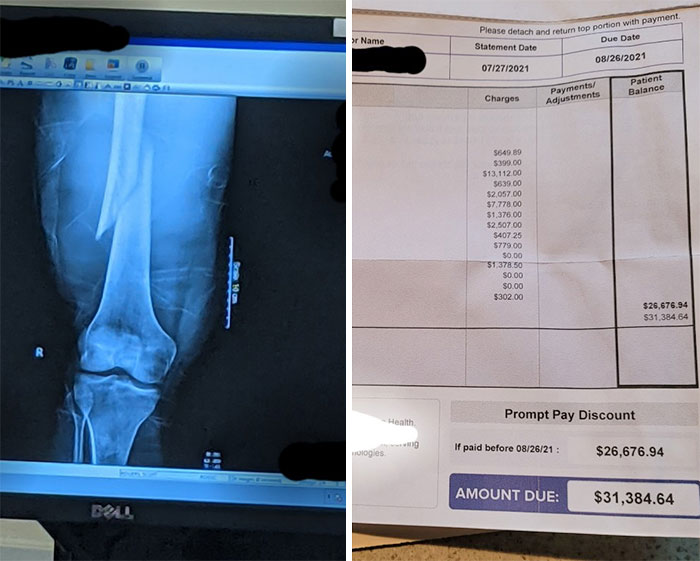 Before And After Of My Uninsured Femur Break