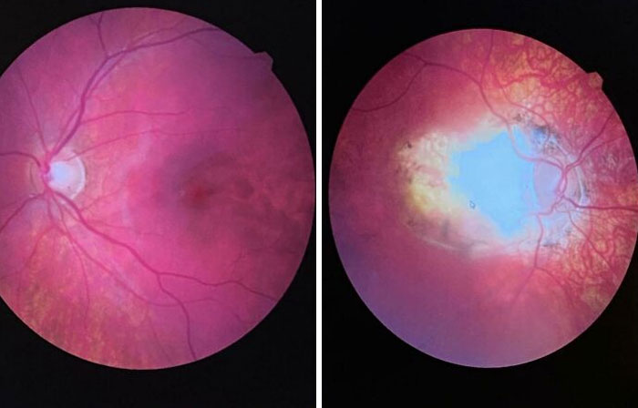 A Scan Of My Normal Eye vs. My Blind Eye