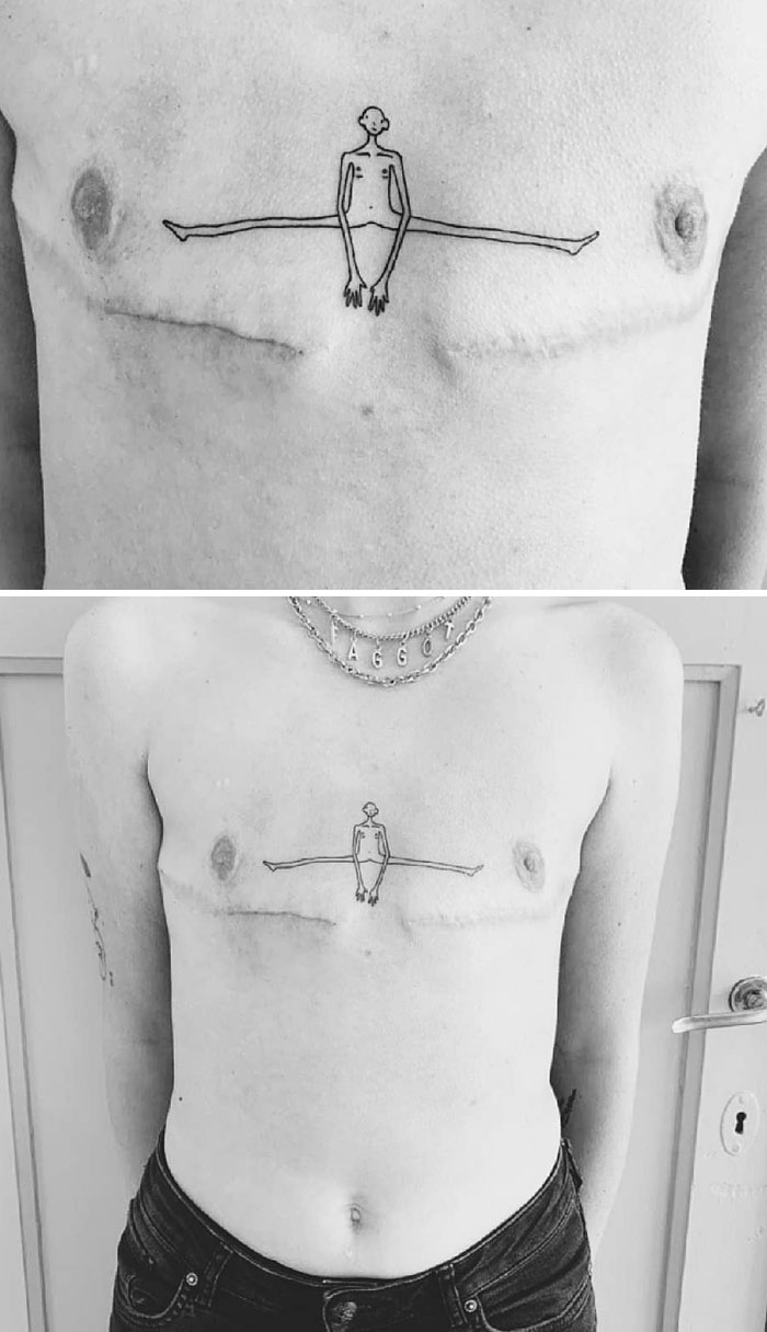 Here's My New Trans Tattoo To Go With My Top Surgery Scars. I Am In Love