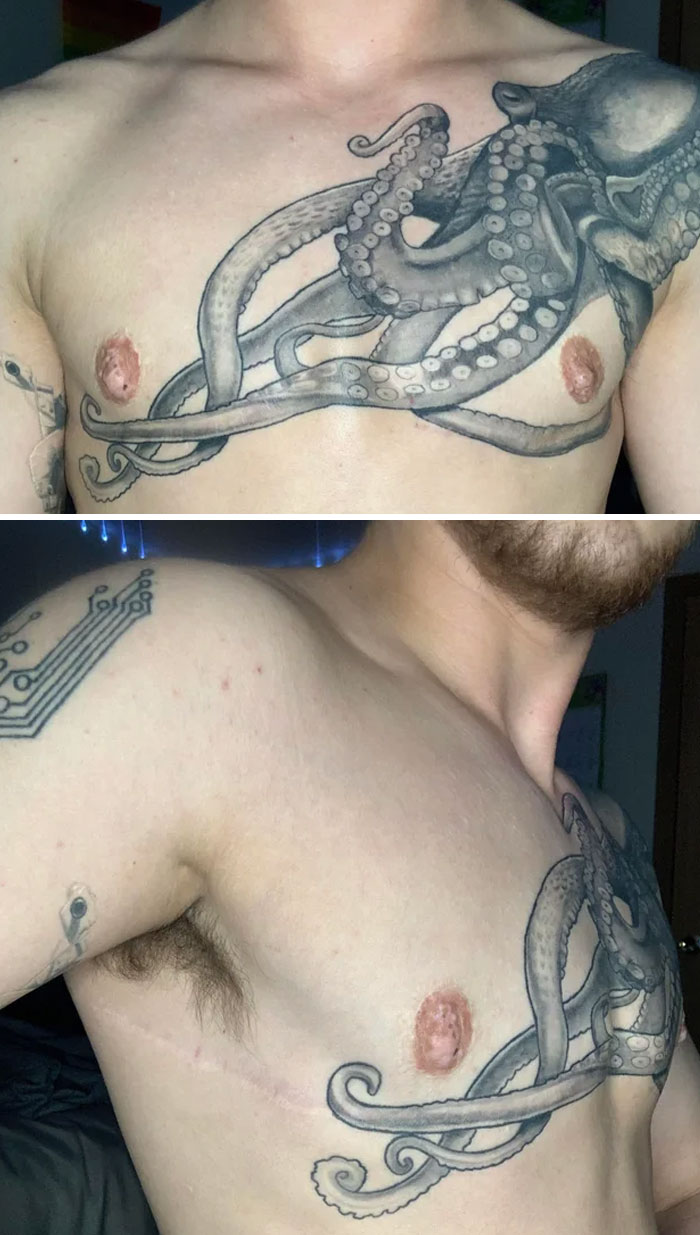 Octopus tattoo artistically covers chest scar, blending design with skin seamlessly.