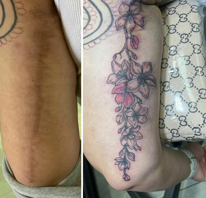 Covered A Pair Of Scars On One Brave Lady