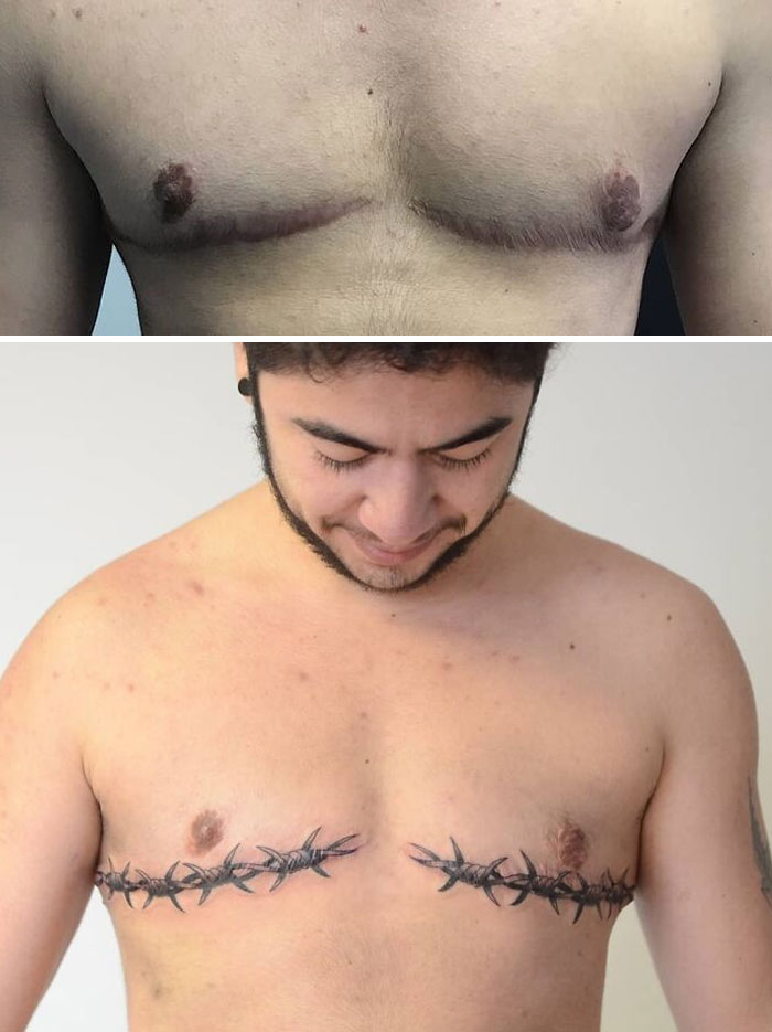 Tattoo cover-up transforms chest scars into barbed wire art, enhancing appearance and confidence.
