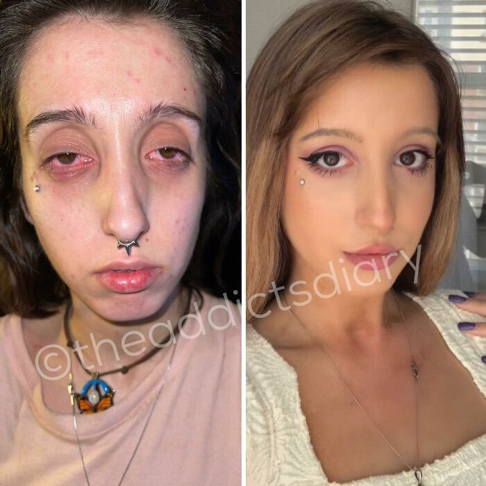 ‘The Addict’s Diary’: 30 Powerful Before & After Transformations Of Drug Addicts (New Stories)