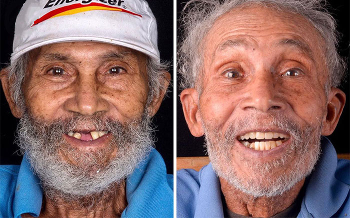 Brazilian Dentist Travels To Treat The Teeth Of Poor People For Free And Here Are 30 Transformations
