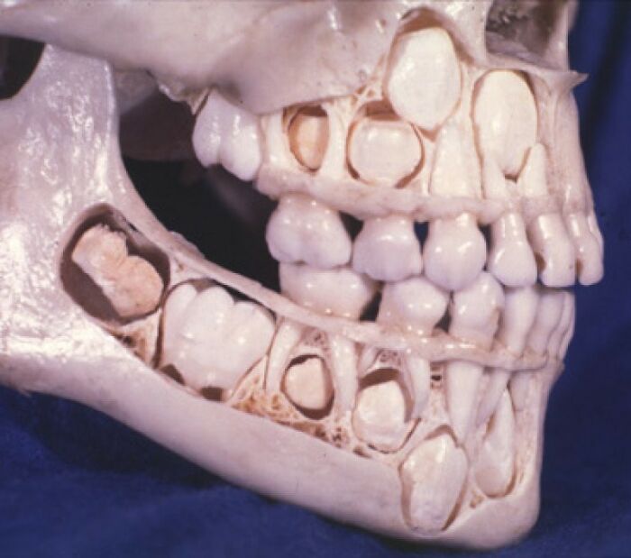 Close-up of a skull showing teeth development with disturbing facts meant to ruin your day and provoke unsettling thoughts.