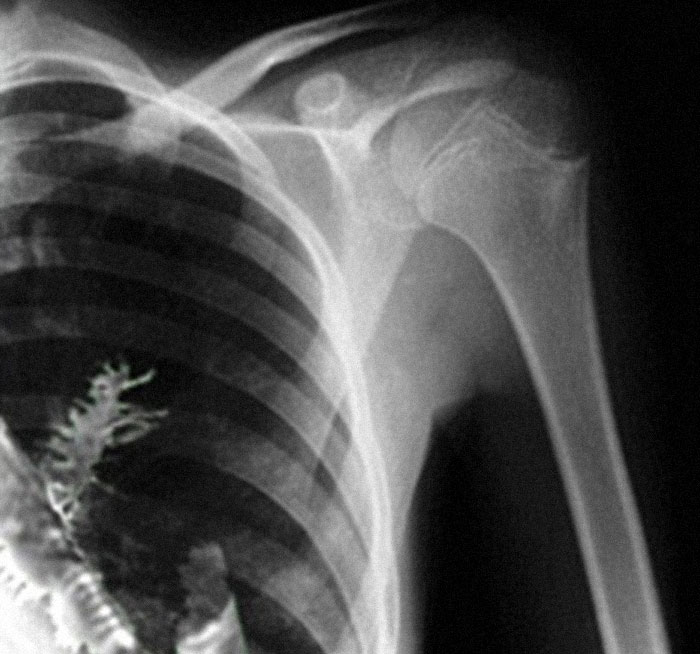 X-ray image of a human chest and shoulder showing ribs and upper arm bone related to disturbing facts topic.