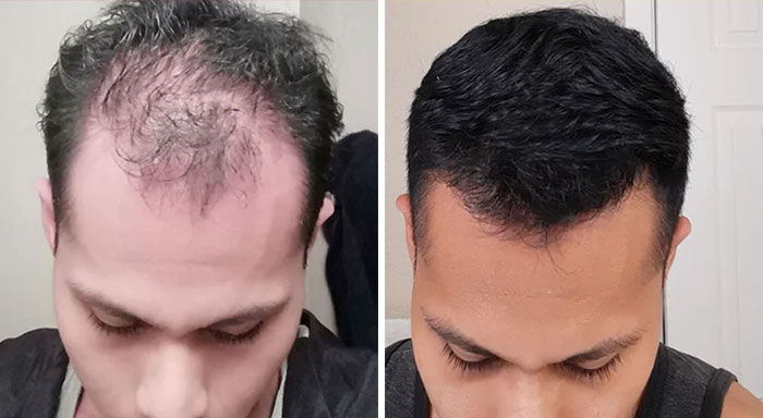 People Who Tried Out Hair Loss Treatments Are Sharing Their Results In This Dedicated Online Community (30 Pics)