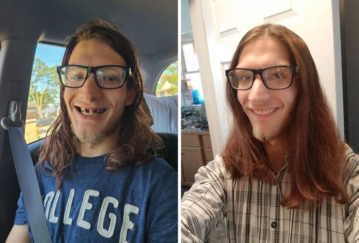 After Years Of Tooth Pain And Hiding My Smile, I Got Dentures! They Literally Made Me Smile