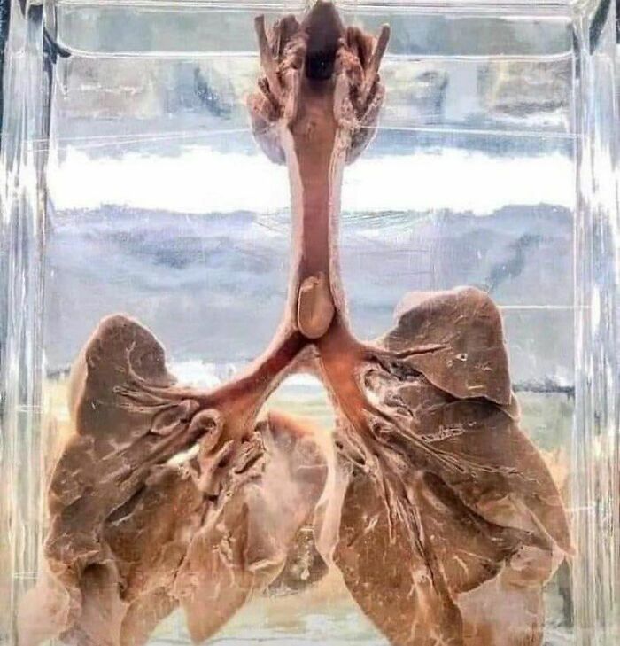 A Peanut Lodged Inside A Child's Trachea