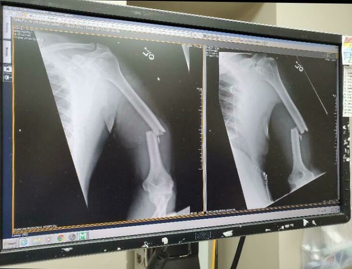 My (Nearly 60 Y/O) Fathers Arm After Being Thwomped By A Cow This Morning