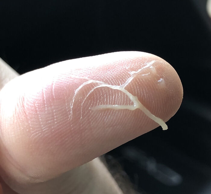 Dealing With A Lung Infection And Coughed Up A Bronchial Cast - A Mucosal Plug That Retained The Shape Of The Bronchioles It Came Out Of