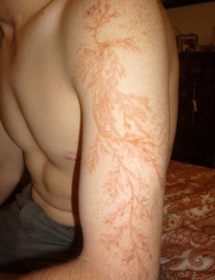 Lightning Strike Survivor