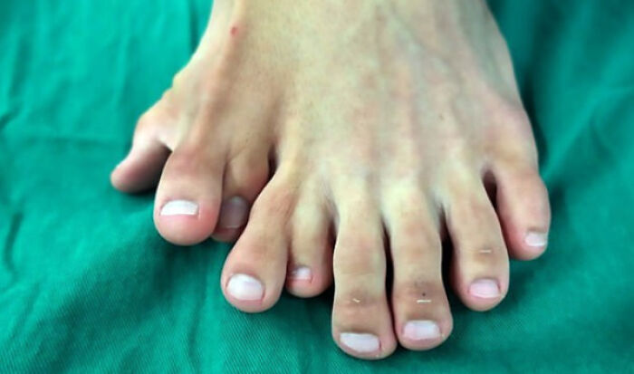 Polydactyly Surgery - Full Case