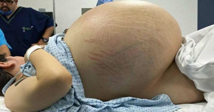 33kg Ovarian Cyst - Full Case